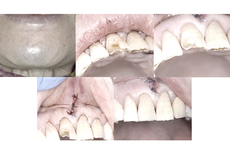 転倒によるオトガイ部打撲・上唇小帯裂傷・上顎前歯部の外傷性歯冠破折および点状露髄